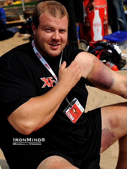 Getting banged up a little is part of strongman: When his left hand slipped on the Block Lift at World’s Strongest Man 2010, Dave Ostlund got the bruise you see on his left arm.  The abraded left leg is from getting the Africa Stone into position.  IronMind® | Randall J. Strossen photo.